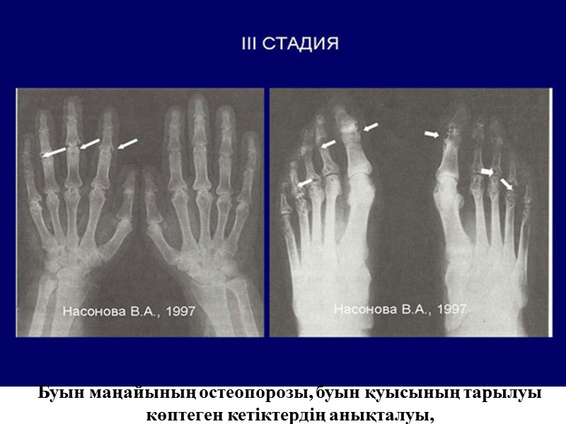 Буын маңайының остеопорозы, буын қуысының тарылуы көптеген кетіктердің анықталуы,